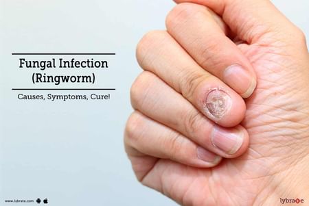Ringworm treatment, causes, symptoms and risk factors