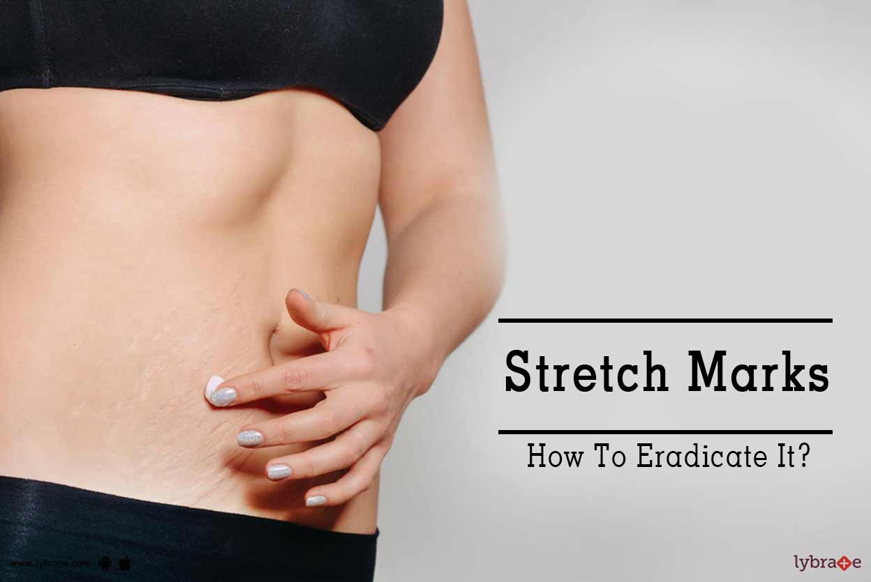 stretch marks hatane ke liye cream