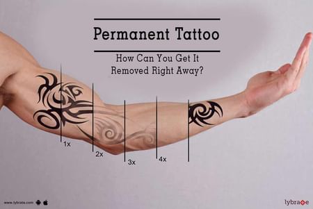 Tattoo Removal Tips & Advice From Top Doctors | Lybrate