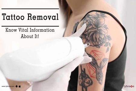 Tattoo Removal Tips & Advice From Top Doctors | Lybrate