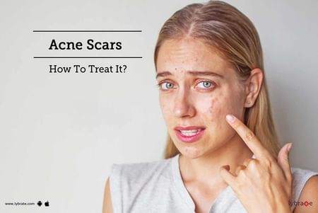 Acne Scars - How To Treat It? - By Dr. Manju Keshari | Lybrate