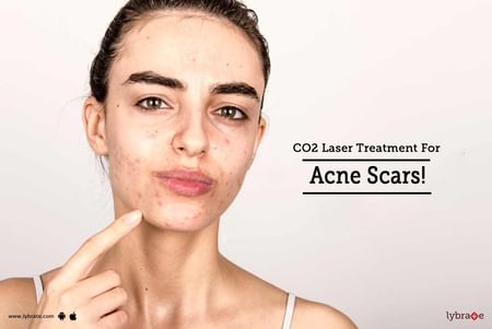 Laser Treatment For Acne Scars Procedure Cost Recovery Side