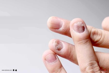 Fungal Nail Infection - How To Treat It? - By Dr. Amit Luthra | Lybrate
