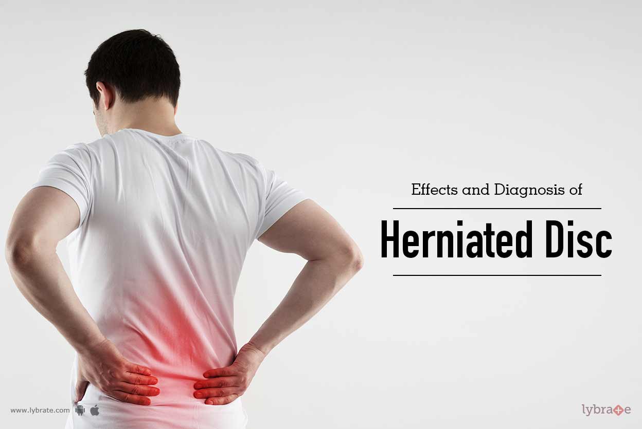 disc effects herniated sex side Student solution beginning intermediate algebra gay