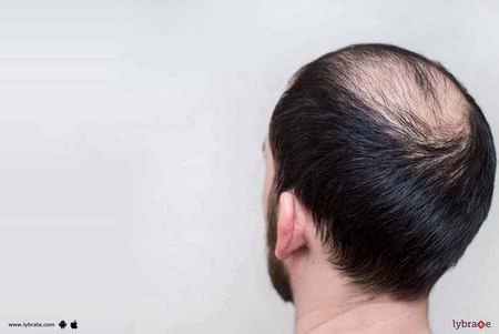Baldness - How Ayurveda Can Help? - By Arogyadham Treatment Centre | Lybrate