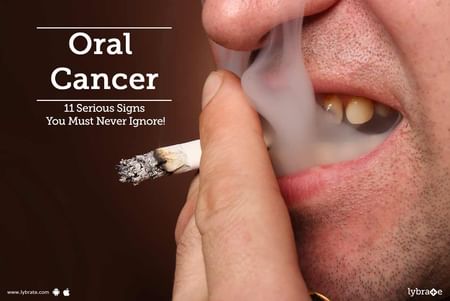 Resultado de imagen de oral cancer