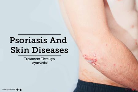 psoriasis skin disease treatment