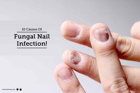 Fungal Nail Infection: Causes and Treatments - Dr Nathan Holt