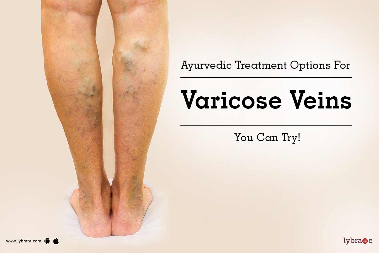 ayurveda varicose veins