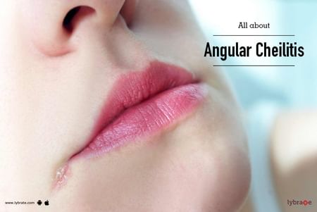 All About Angular Cheilitis By Dr Sandesh Gupta Lybrate