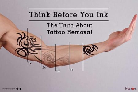 Indian Ink Tattoo Removal  North Bristol NHS Trust