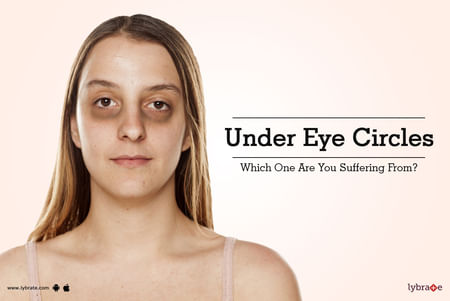 Under Eye Circles Which One Are You Suffering From By Dr Vivek Mehta Lybrate