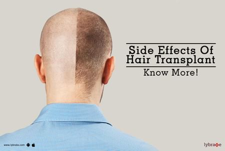 Side Effects Of Hair Transplant - Know More! - By Dr. Gajanan Anand Jadhao  | Lybrate