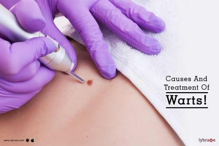 Causes And Treatment Of Warts! - By Cosmetica Skin Laser & Hair Transplant  Centre | Lybrate
