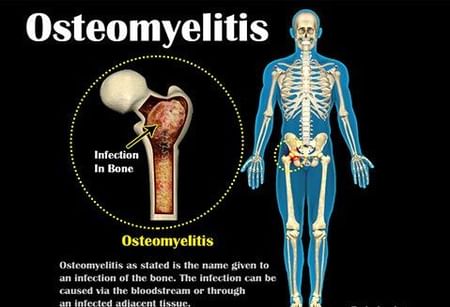 Image result for osteomyelitis