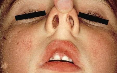 Nasal Disorders_Typhus Fever_Typhus_Scrub_Dr_Qaisar_Ahmed_Dixe_Cosmetics
