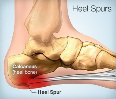 heel spur homeopathic remedy