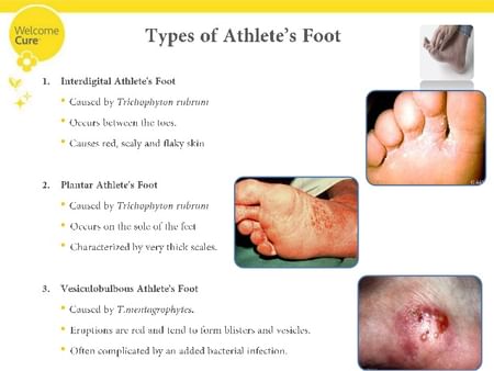Athlete's Foot Tips \u0026 Advice From Top 
