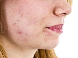 Mupivate Ointment Tips Advice From Top Doctors Lybrate
