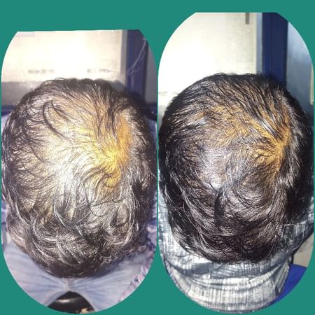 Androgenetic Alopecia Treatment By Medicine! - By Dr. Sandeep Gupta |  Lybrate