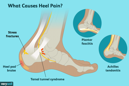 pain in heel of foot homeopathic remedy