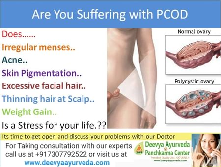 PCOS And Hair Loss Treatment - By Dr. Ritesh Chawla | Lybrate