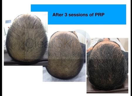 5 Benefits of PRP after Hair Transplant | Is PRP useful ? - Dr. Deepak P  Devakar | Doctors' Circle - YouTube