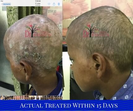 Fungal Infection on Scalp - Tinea Capitis - By Dr. Arshad Khan | Lybrate