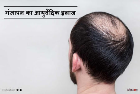 गंजापन का आयुर्वेदिक इलाज - Ganjapan Ka Ayurvedic Ilaj! - By Dr. Sanjeev  Kumar Singh | Lybrate