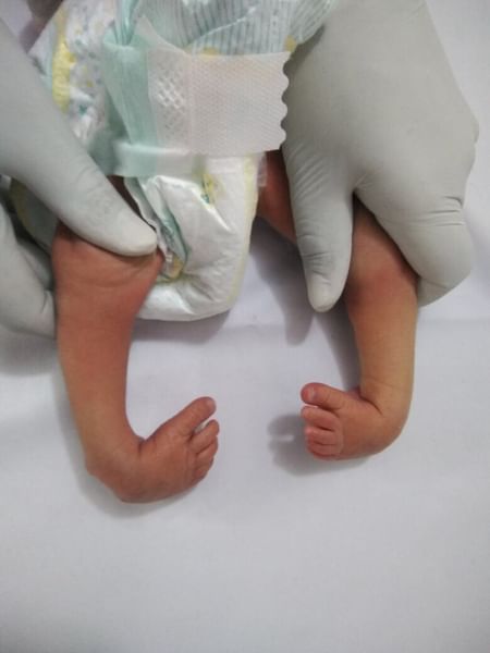 Clubfoot What You Need To Know By Dr Nargesh Agrawal Lybrate
