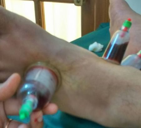 Cupping therapy in heel pain - By Dr 