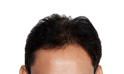 Localized Scaly Hair Loss  SpringerLink