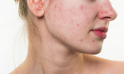 Rosacea & Answers, What Rosacea? | Lybrate