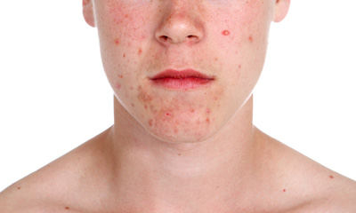 bengel cream for pimples