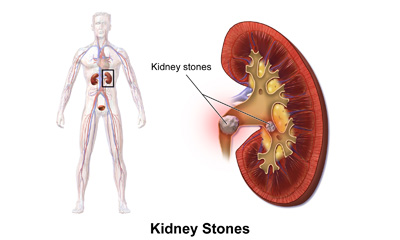 Kidney Stones Questions Answers What Is Kidney Stones Lybrate