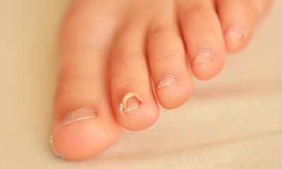 treatment of nail fungus in child