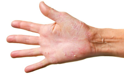 treating skin allergies male 09091