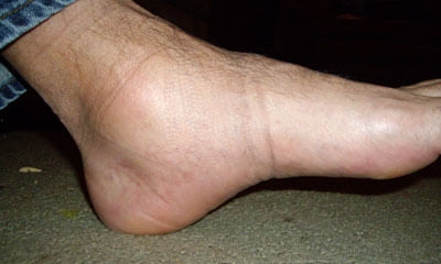 Swelling In Toe Questions Answers What Is Swelling In Toe Lybrate