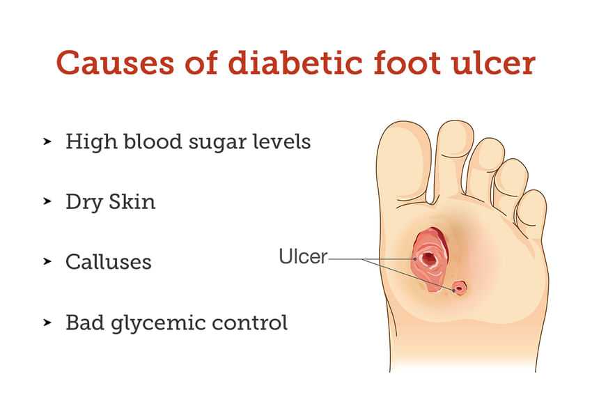 Diabetic Foot Ulcer: Symptoms, Causes, Treatment and Cost
