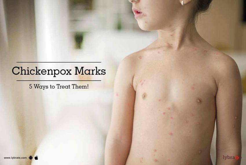 Chickenpox Marks - 5 Ways to Treat Them!