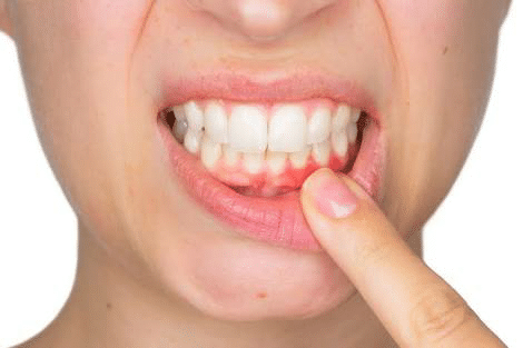 Periodontitis How To Deal With It By Dr Premendra Goyal Lybrate