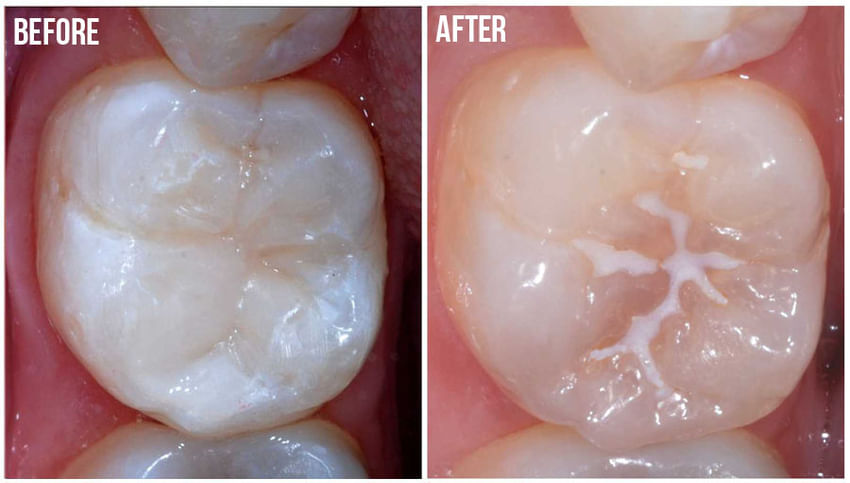 Pit and Fissure Sealant