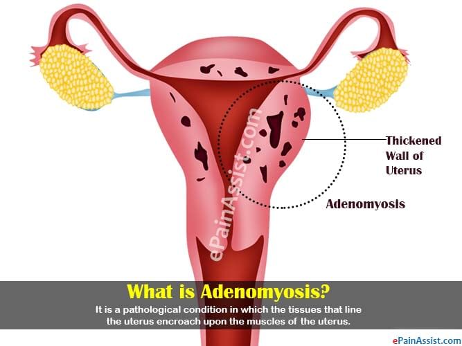 Homoeopathic Treatment Of Adenomyosis By Dr Jyoti Singh Lybrate