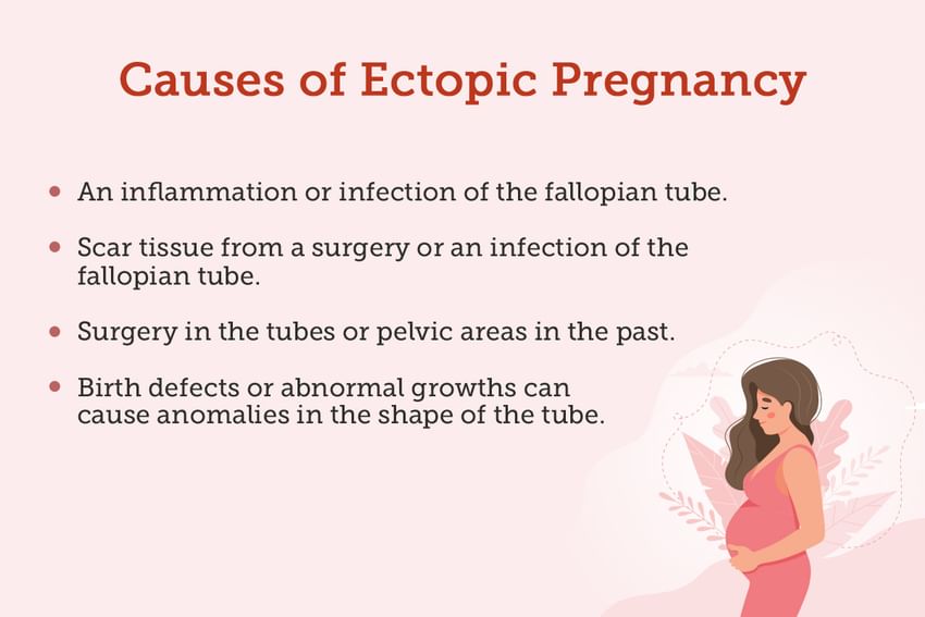 Ectopic Pregnancy Causes Symptoms Treatments And More 2668