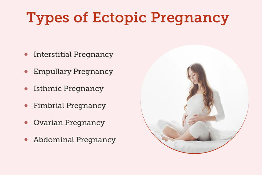 Ectopic Pregnancy Causes Symptoms Treatments And More 1297