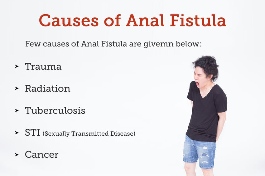 Anal Fistula Treatment Procedure Cost Recovery Side Effects And More 