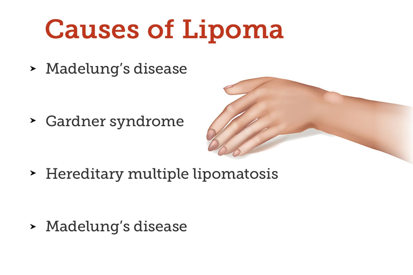 lipoma-symptoms-causes-treatment-and-cost