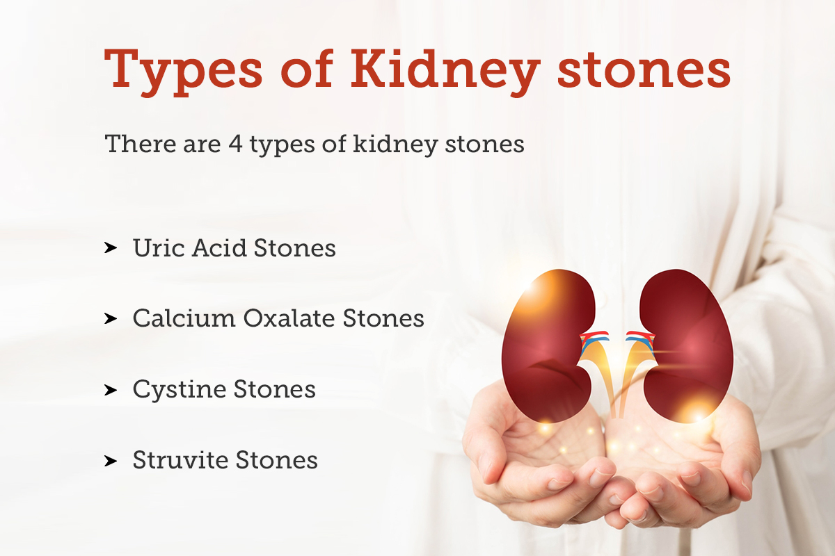 Kidney Stones Causes, Symptoms, Treatments And More