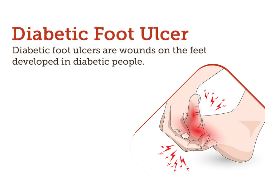 Diabetic Foot Ulcer Symptoms Causes Treatment And Cost 