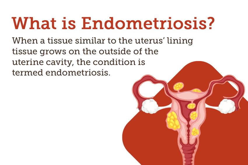 What Causes Endometriosis Lesions